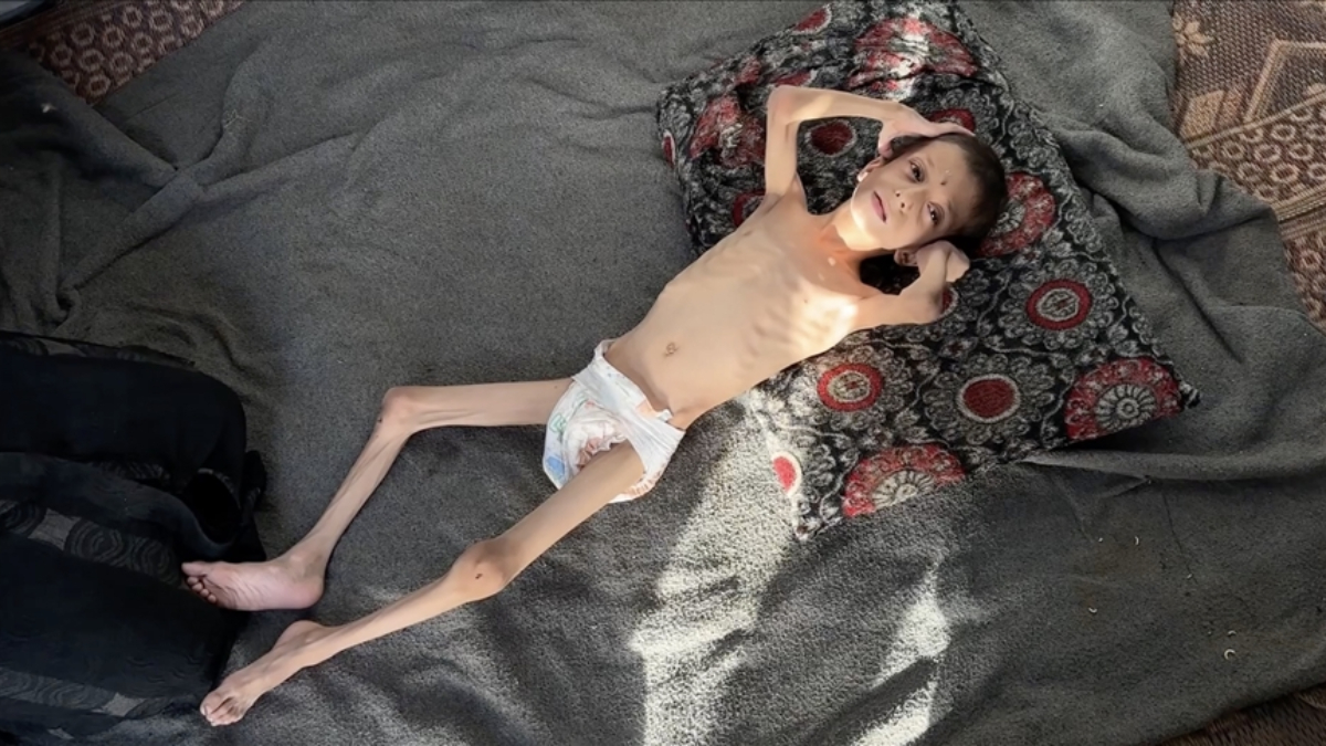 israilin kitliga surukledigi 10 yasindaki nafiz kemik yiginina donustu RPhsMMF2